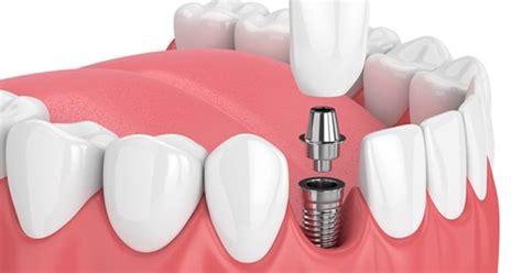 implante dentário preço.